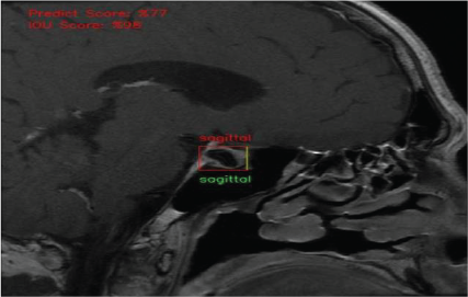 MRI scan — pituitary detection